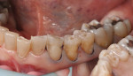 Fig 10. Class 5 preparations after removal of the caries and old restorative material from the mandibular left quadrant.