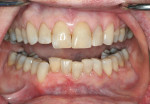 Fig 12. The final single-shade composite restorations immediately after restoration of the fourth and final quadrant, the mandibular left.
