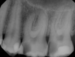Fig 1. Preoperative bitewing radiograph. Tooth No. 14 was slightly sensitive to percussion due to gingival irritation; patient complained of sensitivity to cold lingering for approximately 5 to 7 seconds. Periodontal probing revealed no pockets. The diagnosis for tooth No. 14 was symptomatic irreversible pulpitis.