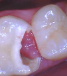 Fig 2. Caries removal.
