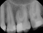 Fig 13. Postoperative bitewing radiograph. The patient had no discomfort at 1-week follow-up. (Procedural photographs were provided by Dr. Leibow and Jonathan Sorsak.)