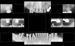 (1.) Preoperative full mouth series of radiographs.