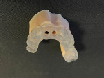 (6.) Extraoral view of the 3D printed surgical guide being confirmed on the 3D printed model.