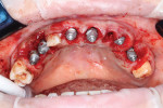 (12.) Post-implant placement, a scan was acquired using scan bodies and the remaining triad of teeth.