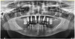 (16.) Postoperative panoramic radiograph confirming full seating of the provisional prosthesis.