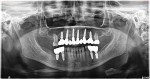 (22.) Final panoramic radiograph acquired to confirm proper seating of the final screw-retained restorations.