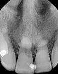 (1.) Pretreatment radiograph demonstrating external root resorption at the cervical aspect of the maxillary right central incisor.