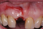 (2.) Retracted close-up view of the site of the maxillary right central incisor following extraction demonstrating a noticeable buccal concavity on the ridge.