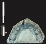 (4.) Fabrication of the diagnostic guide involved the use of a 3/32” drill to estimate osteotomy position on the model, placement of a 3-mm guide post and a 3-mm guide sleeve, the addition of modeling resin to stabilize the guide sleeve, and the further addition of resin until it was complete.