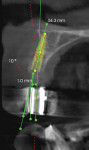 (7.) CBCT crosssectional view of the extraction site acquired with the diagnostic guide in place demonstrating an insufficient facial ridge when virtual implant planning was performed with a 10° angle correction and 1-mm linear correction.