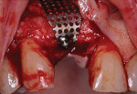 (9.) Intraoral view of the titanium mesh placed over the graft material and fixated to the crest of the ridge with a screw.