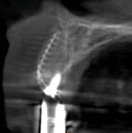 (12.) Four months after graft placement, a CBCT scan was acquired with the diagnostic guide in place to evaluate the augmented ridge for virtual implant planning.