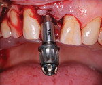 (21.) The implant was placed through the surgical guide.