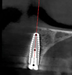 (22.) Immediate postoperative CBCT cross-sectional view demonstrating complete encapsulation of the implant within the osseous ridge.