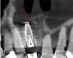 (23.) Immediate postoperative CBCT tangential view showing the implant placement in relation to the adjacent teeth and anatomy.