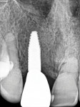 (25.) Final periapical radiograph of the completed implant-supported restoration.