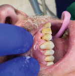 (2.) Posttreatment view after use of the DentaLaze for retraction and hemostasis revealed that the restoration had open margins and enabled the clinician to properly marginate it without bleeding obscuring the visibility.