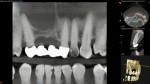 Fig 2. CBCT views showing preoperative situation, including frontal, horizontal, and sagittal planes.