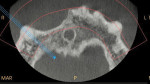 Fig 3. CBCT preoperative transverse view of class IV ridge.