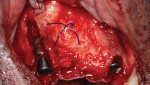 Fig 4. Frontal view of horizontal PDS suture tenting.