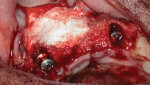 Fig 6. First tranche of synthetic bone graft placed on horizontal ridge defect tent.