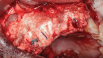 Fig 7. Second tranche of synthetic bone graft placed on vertical defect tent.