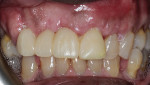 Fig 10. Two weeks postoperative at suture removal.