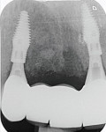 Fig 12. Plane radiograph at the time of bridge fit.