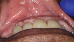 Fig 14. Occlusal
view of definitive bridge
and ridge volume at 13 months
post-surgery.