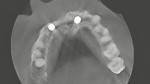 Fig 15. CBCT scan,
horizontal view, showing implants
and ridge volume at 13 months
post-surgery.