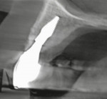 Fig 16. CBCT scan,
sagittal plane, showing maxillary
left central incisor implant and
labial bone volume.