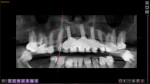 Fig 4. Pretreatment orthopantomogram.