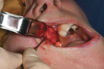 Fig 5. Raised full-thickness flap, tooth extracted.