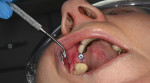 Fig 11. Healing abutment placed at 3 months.