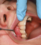 Fig 13. Clinical view of final restoration at 3 months.