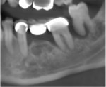 Fig 1. Section of a CBCT demonstrating significant radiographic bone loss on the third molar (No. 17) with hyper-eruption, with bone loss on the mesial and distal of the second molar (No. 18) and the distal of the second premolar (No. 20).