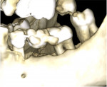 Fig 2. CBCT reconstructed 3D view demonstrating the bone loss on teeth Nos. 17, 18, and 20.