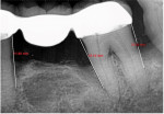 Fig 3. Radiograph showing the second premolar (No. 20) with an initial depth of 11.6 mm of bone loss from the crown margin, and the mesial and distal of the second molar (No. 18) of 12.14 mm and 10.24 mm, respectively.