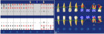 Fig 4. Pretreatment periodontal charting of the mandibular left quadrant demonstrating significant probing on teeth Nos. 17, 18, and 20 with associated mobility on Nos. 17 and 18.