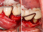 Fig 5: Following minimal flap elevation, periodontal probing showed further evaluation of the osseous defects associated with teeth Nos. 20 (left) and 18 (right).