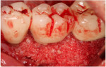 Fig 6. Graft fabricated from dentin derived from extracted tooth No. 17, processed by the dentin grinder, was utilized under the pontic at No. 19. The graft material was partially demineralized and mixed with cancellous allograft in saline and placed into the debrided osseous defects.