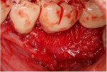 Fig 7. The graft was covered with an amnion-chorion barrier membrane.