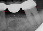 Fig 9. Radiograph at 4-month recall evaluation demonstrating stability of the osseous graft and a reduction of bone loss on the distal of tooth No. 20 to 3.62 mm and on the mesial and distal of tooth No. 18 to 4.69 mm and 4.46 mm, respectively.