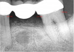 Fig 11. Radiograph at the 8-month recall evaluation demonstrating stability of the osseous graft previously placed with probing on the distal of tooth No. 20 at 3.01 mm and on the mesial and distal of tooth No. 18 at 3.15 mm and 4.69 mm, respectively.