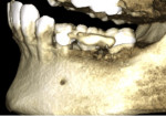 Fig 12. CBCT reconstructed 3D view demonstrating complete infrabony fill and increased supra-alveolar bone levels after 8 months of healing post–osseous grafting.