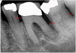 Fig 13. Radiograph showing the mandibular left first molar (No. 19) with bone loss around the distal root, and significant bone loss on the mesial root of the second molar (No. 18) with the following probings: No. 18 distal = 7 mm, No. 18 mesial = 12.74 mm, and No. 20 distal = 5.96 mm.