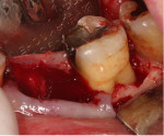 Fig 14. Tooth No. 19 was extracted, a minimal flap was elevated, and the socket and periodontal pockets were debrided in preparation for graft placement.