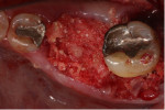 Fig 15. Graft fabricated from dentin derived from extracted tooth No. 19, processed by the dentin grinder. The graft material was partially demineralized and mixed with cancellous allograft in an L-PRF block and placed into the extraction socket and the debrided osseous defects on the adjacent teeth.