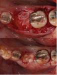 Fig 16. The amnion-chorion barrier membranes were placed over the osseous graft (top), and sutures were placed following repositioning of the flap margins over an L-PRF barrier (bottom).