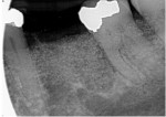 Fig 17. Radiograph after extraction of tooth No. 19 and graft placement in and above all defects.